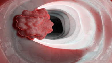 صورة استشاري علاج الأورام توضح السبب الرئيسي لسرطان الأمعاء.. وتكشف عن أبرز أعراضه